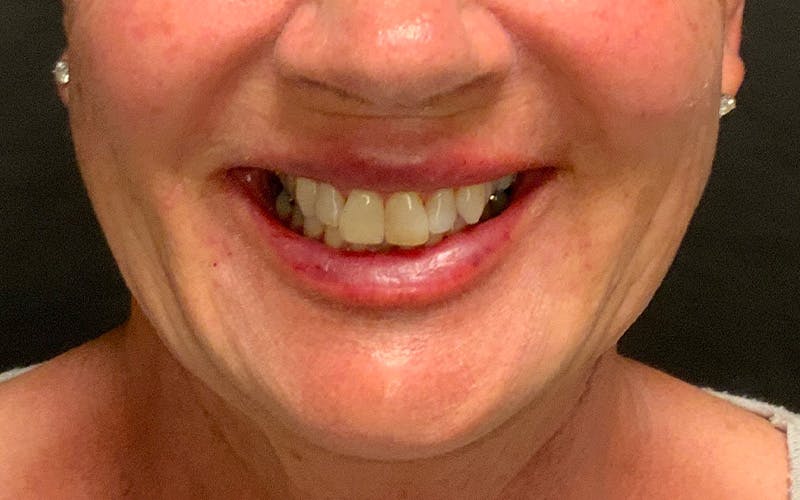 Juvederm / Voluma / Volbella / Kybella Before & After Gallery - Patient 189250 - Image 4