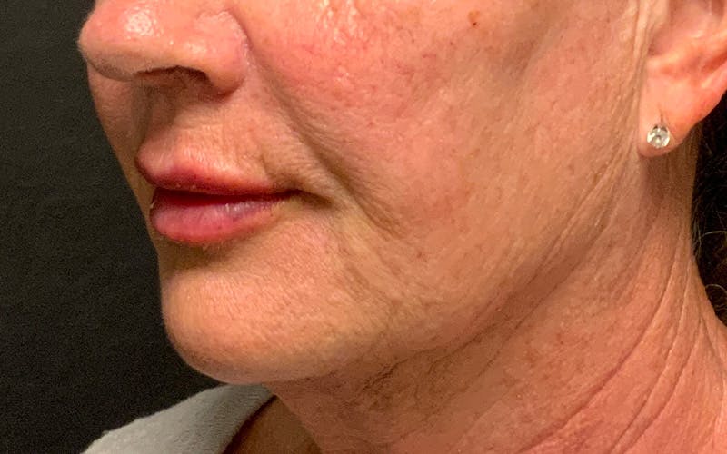 Juvederm / Voluma / Volbella / Kybella Before & After Gallery - Patient 189250 - Image 8