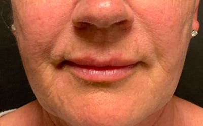 Juvederm / Voluma / Volbella / Kybella Before & After Gallery - Patient 189250 - Image 1