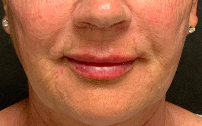 Juvederm / Voluma / Volbella / Kybella Before & After Gallery - Patient 189250 - Image 2