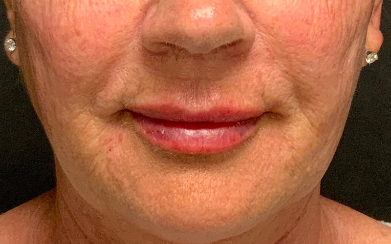 Juvederm / Voluma / Volbella / Kybella Before & After Gallery - Patient 189250 - Image 2