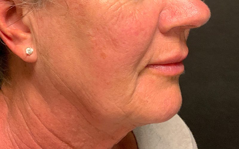 Juvederm / Voluma / Volbella / Kybella Before & After Gallery - Patient 189250 - Image 5