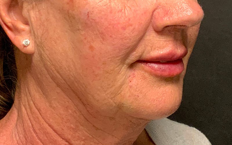 Juvederm / Voluma / Volbella / Kybella Before & After Gallery - Patient 189250 - Image 6