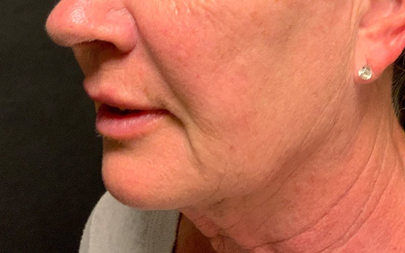 Juvederm / Voluma / Volbella / Kybella Before & After Gallery - Patient 189250 - Image 7