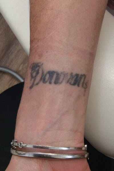 PicoWay Before & After Gallery - Patient 103074 - Image 1