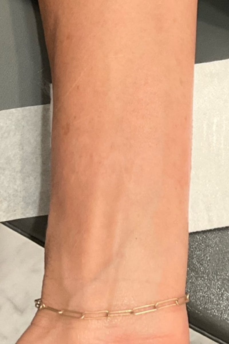 PicoWay Before & After Gallery - Patient 103074 - Image 2