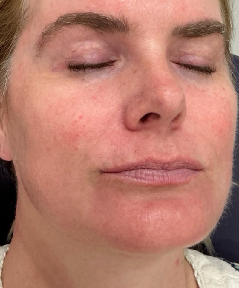 Restylane Before & After Gallery - Patient 236096 - Image 1