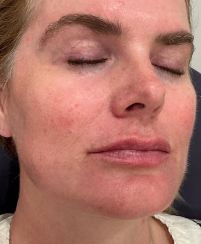 Restylane Before & After Gallery - Patient 236096 - Image 2