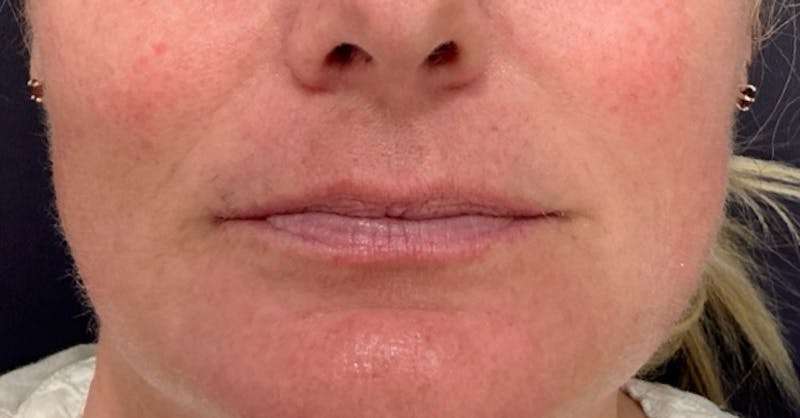 Restylane Before & After Gallery - Patient 236096 - Image 3
