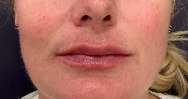 Restylane Before & After Gallery - Patient 236096 - Image 4