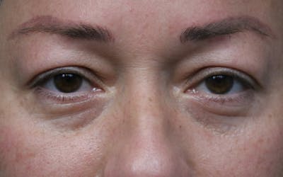 Eyelid Before & After Gallery - Patient 296686 - Image 1
