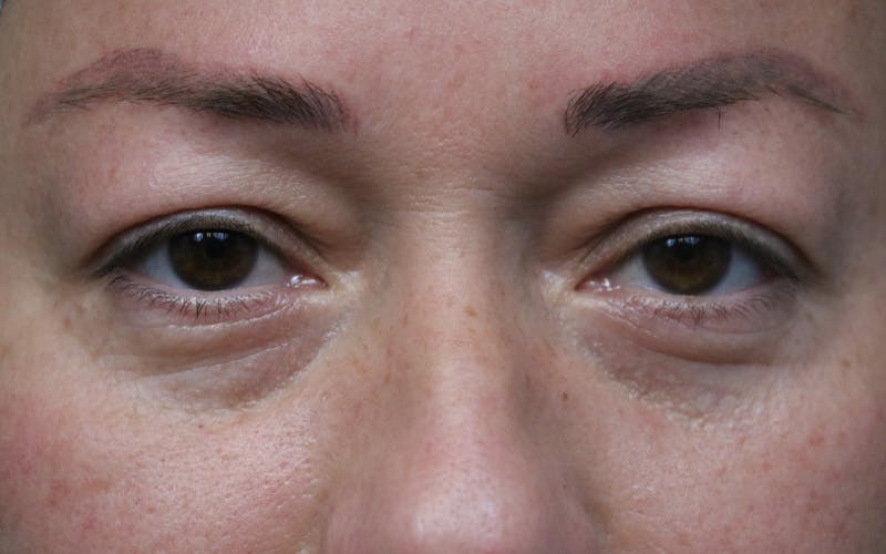 Eyelid Before & After Gallery - Patient 296686 - Image 1