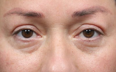 Eyelid Before & After Gallery - Patient 296686 - Image 2