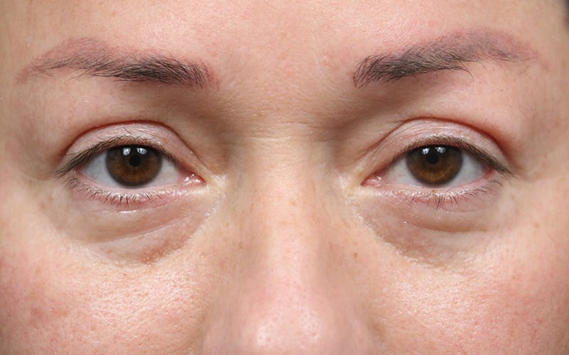 Eyelid Before & After Gallery - Patient 296686 - Image 2