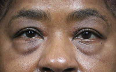 Eyelid Before & After Gallery - Patient 407332 - Image 1