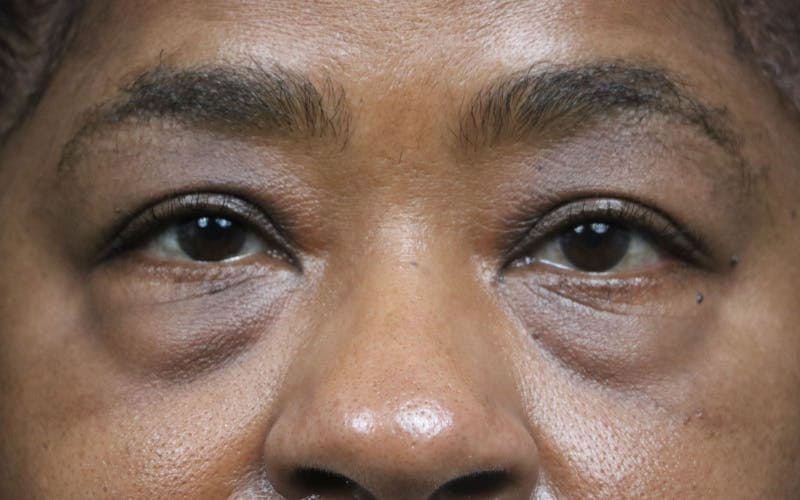 Eyelid Before & After Gallery - Patient 407332 - Image 1