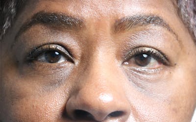 Eyelid Before & After Gallery - Patient 407332 - Image 2