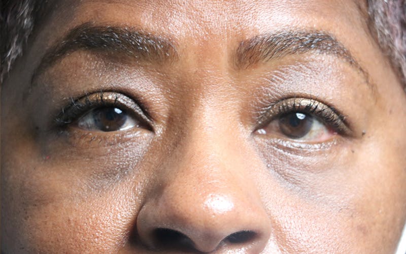 Eyelid Before & After Gallery - Patient 407332 - Image 2