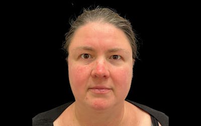 Hydrafacial Before & After Gallery - Patient 290536 - Image 1