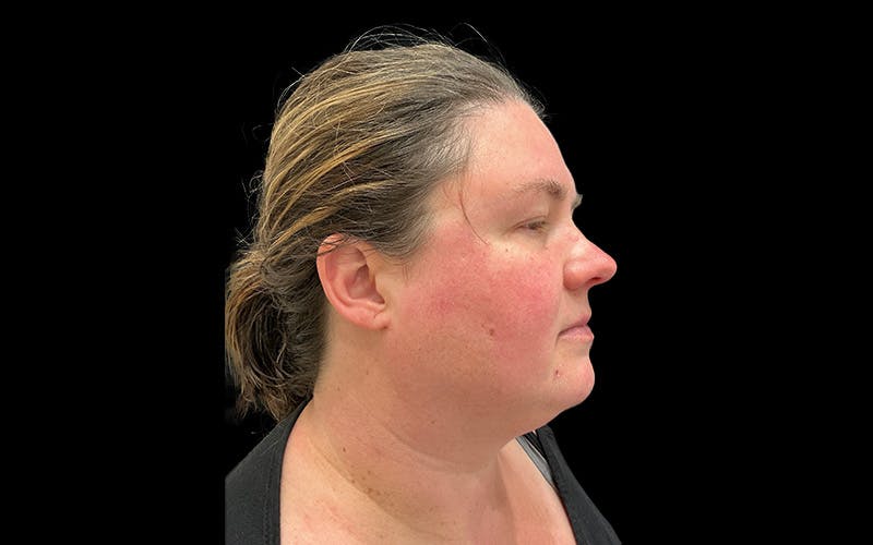 Hydrafacial Before & After Gallery - Patient 290536 - Image 3