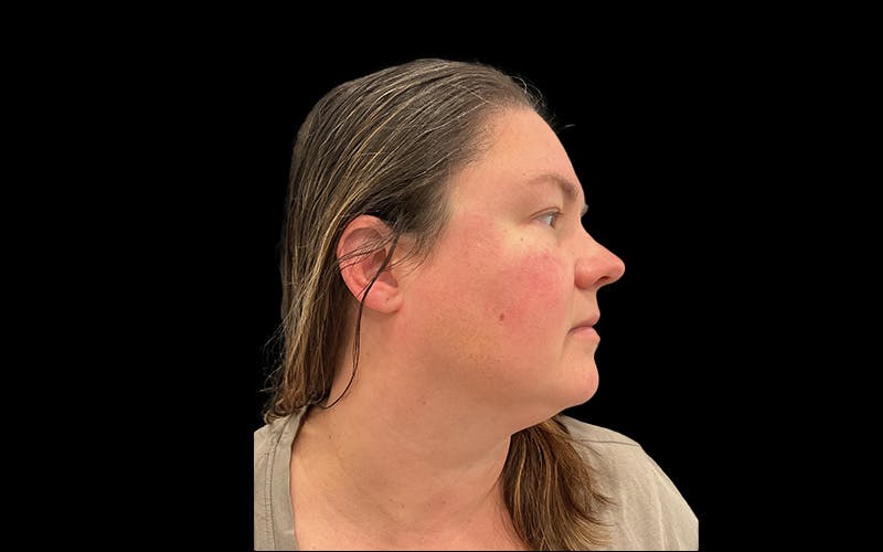 Hydrafacial Before & After Gallery - Patient 290536 - Image 4