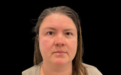 Hydrafacial Before & After Gallery - Patient 290536 - Image 2