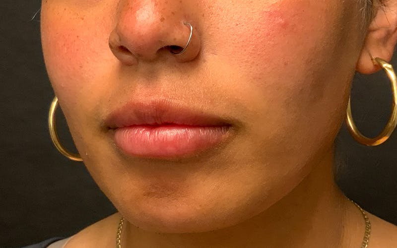 Juvederm / Voluma / Volbella / Kybella Before & After Gallery - Patient 517577 - Image 3