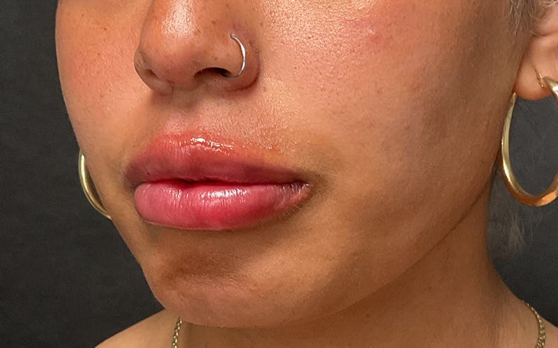 Juvederm / Voluma / Volbella / Kybella Before & After Gallery - Patient 517577 - Image 4