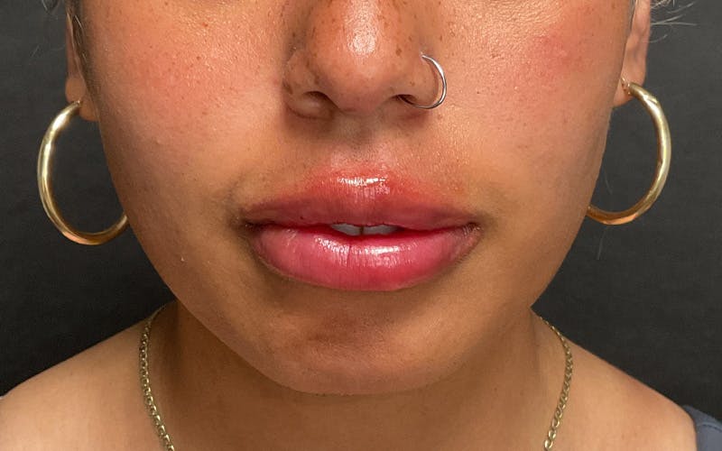 Juvederm / Voluma / Volbella / Kybella Before & After Gallery - Patient 517577 - Image 2