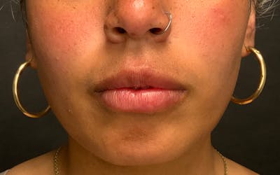 Juvederm / Voluma / Volbella / Kybella Before & After Gallery - Patient 517577 - Image 1