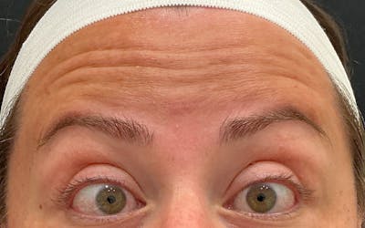 Botox / Dysport Before & After Gallery - Patient 343652 - Image 1