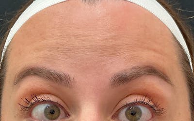 Botox / Dysport Before & After Gallery - Patient 343652 - Image 2