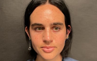 Morpheus8 Before & After Gallery - Patient 127084 - Image 1