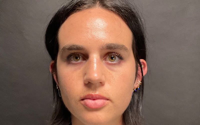 Morpheus8 Before & After Gallery - Patient 127084 - Image 2