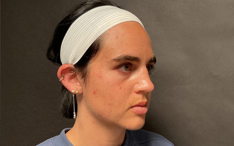 Morpheus8 Before & After Gallery - Patient 127084 - Image 3