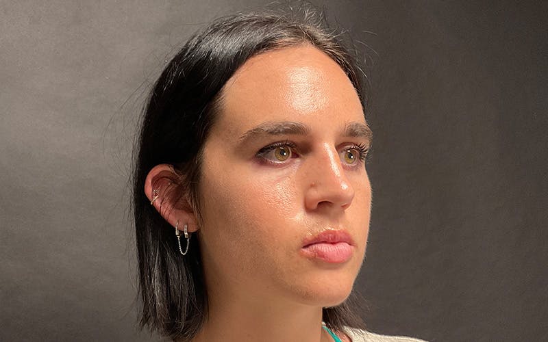 Morpheus8 Before & After Gallery - Patient 127084 - Image 4