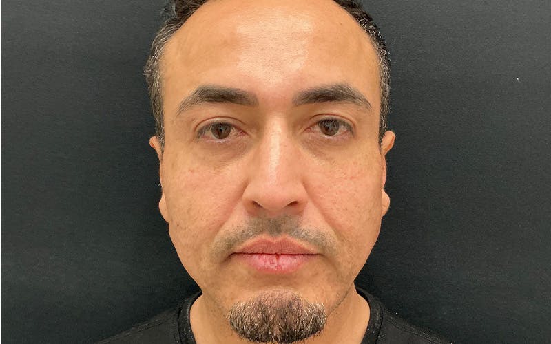 Ultherapy Before & After Gallery - Patient 203206 - Image 1