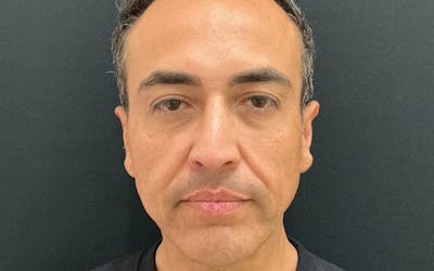 Ultherapy Before & After Gallery - Patient 203206 - Image 2