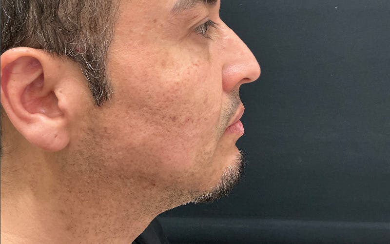 Ultherapy Before & After Gallery - Patient 203206 - Image 3