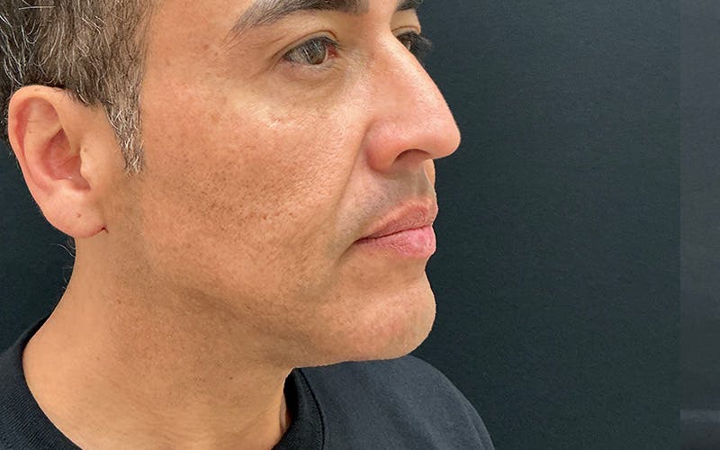 Ultherapy Before & After Gallery - Patient 203206 - Image 4