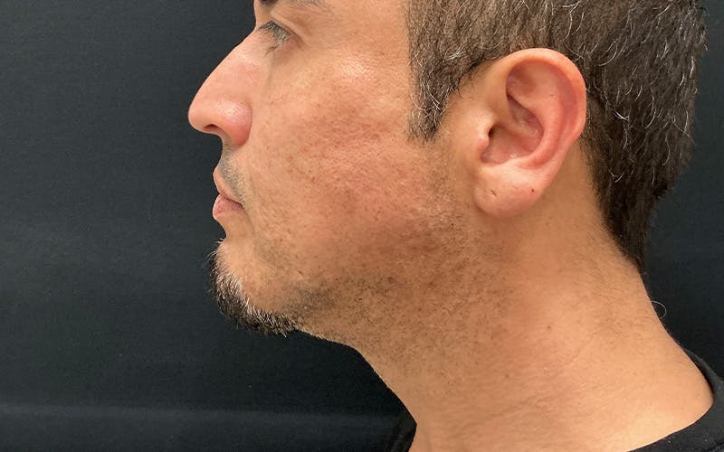 Ultherapy Before & After Gallery - Patient 203206 - Image 5