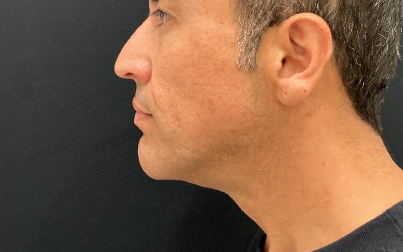 Ultherapy Before & After Gallery - Patient 203206 - Image 6