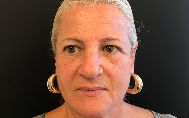 Juvederm / Voluma / Volbella / Kybella Before & After Gallery - Patient 206956 - Image 1