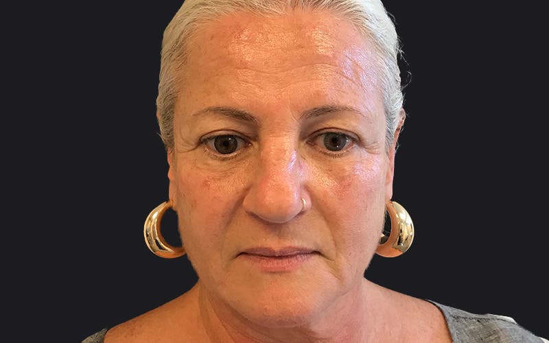 Juvederm / Voluma / Volbella / Kybella Before & After Gallery - Patient 206956 - Image 2