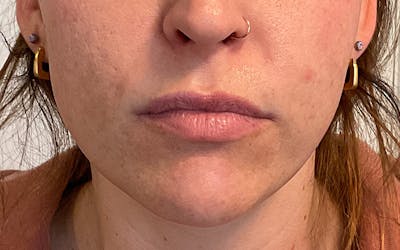 Juvederm / Voluma / Volbella / Kybella Before & After Gallery - Patient 224625 - Image 1