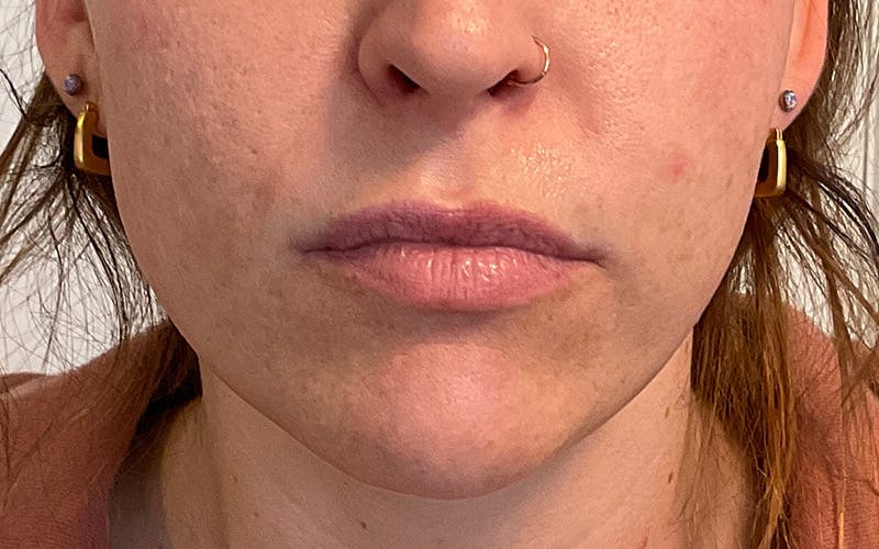 Juvederm / Voluma / Volbella / Kybella Before & After Gallery - Patient 224625 - Image 1