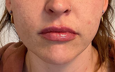 Juvederm / Voluma / Volbella / Kybella Before & After Gallery - Patient 224625 - Image 2