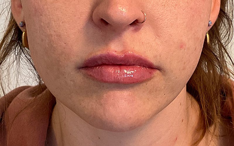 Juvederm / Voluma / Volbella / Kybella Before & After Gallery - Patient 224625 - Image 2