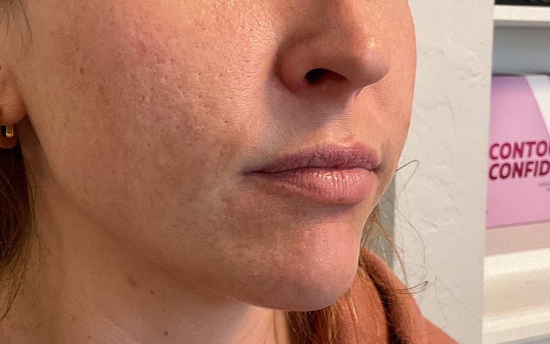 Juvederm / Voluma / Volbella / Kybella Before & After Gallery - Patient 224625 - Image 3
