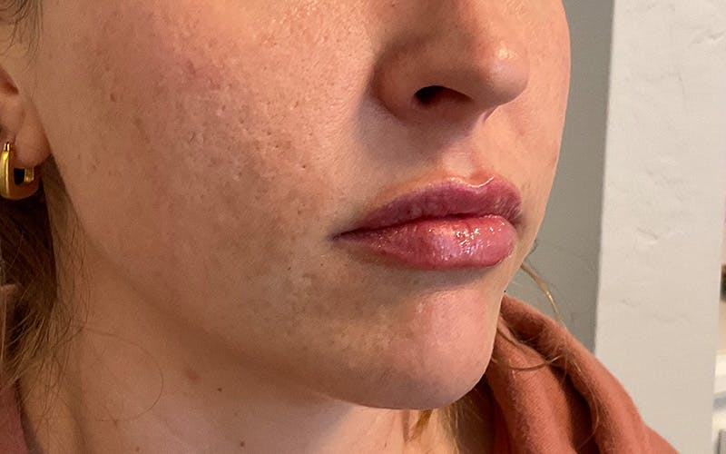 Juvederm / Voluma / Volbella / Kybella Before & After Gallery - Patient 224625 - Image 4